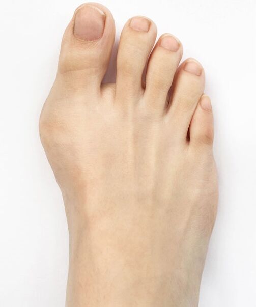 Hallux valgus before using the Hondro Sol Valgus spray