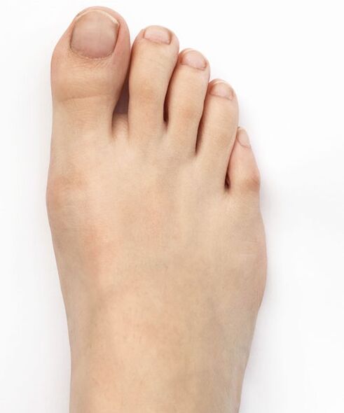 I healed my thumb valgus with Hondro Sol Valgus spray