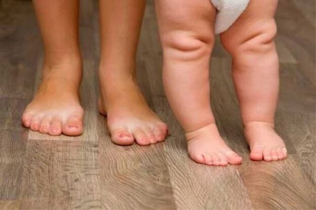 Valgus deformation