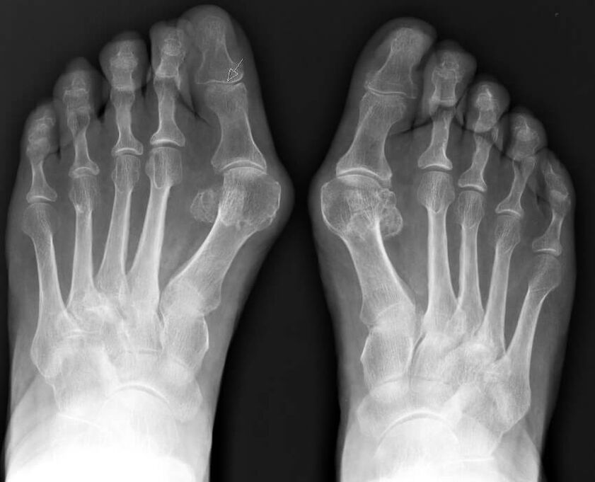 X-ray of the hallux valgus
